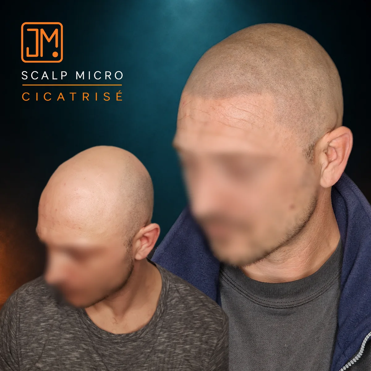 Résultat cicatrisé de micropigmentation capillaire JM.Micro — cas 24